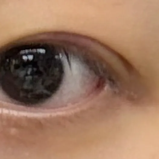 Lateral canthoplasty — Afternoon Plastic Surgery 2