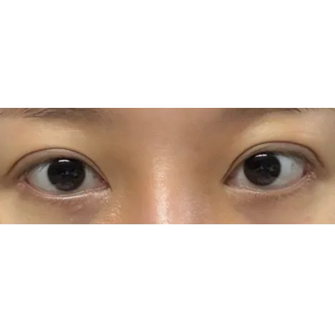 Epicanthoplasty Revision (Reconstruction), Puffy Eyelid Correction, Lateral canthoplasty — Afternoon Plastic Surgery 2