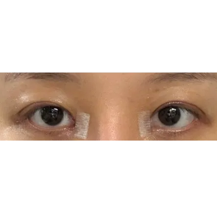 Epicanthoplasty Revision (Reconstruction), Puffy Eyelid Correction, Lateral canthoplasty 1