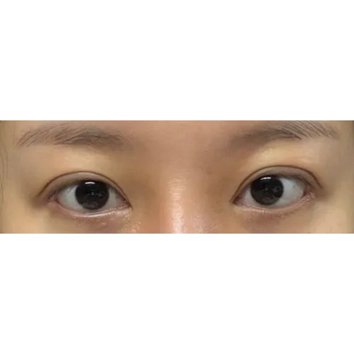 Lateral canthoplasty, Epicanthoplasty Revision (Reconstruction), Puffy Eyelid Correction 1