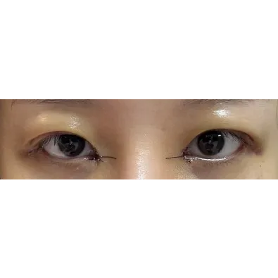 Lateral canthoplasty, Epicanthoplasty Revision (Reconstruction), Puffy Eyelid Correction — Afternoon Plastic Surgery 3