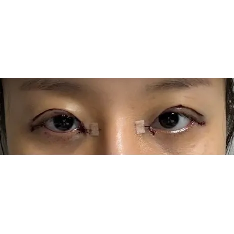 Lateral canthoplasty, Epicanthoplasty Revision (Reconstruction), Puffy Eyelid Correction — Afternoon Plastic Surgery 2