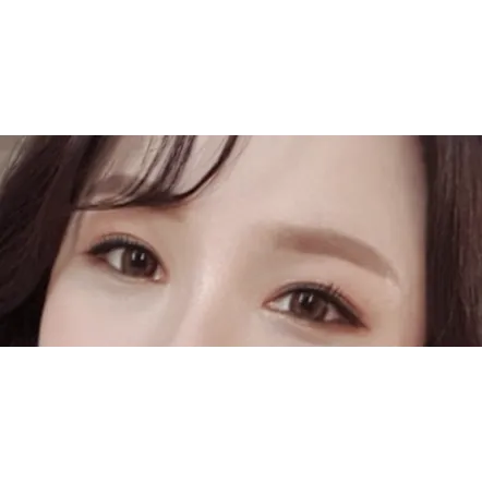 Incisional Double Eyelid Surgery, Ptosis Correction — Afternoon Plastic Surgery 1