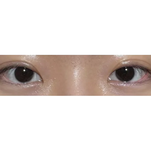 Puffy Eyelid Correction — Afternoon Plastic Surgery 1