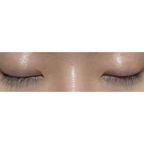 Puffy Eyelid Correction 2