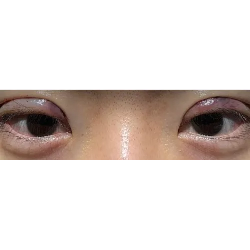 Puffy Eyelid Correction — Afternoon Plastic Surgery 3