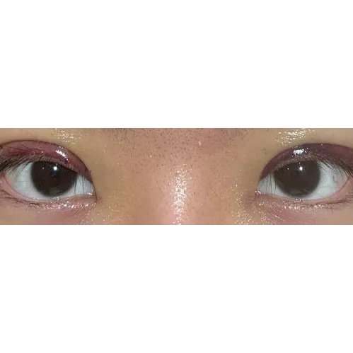 Puffy Eyelid Correction — Afternoon Plastic Surgery 4