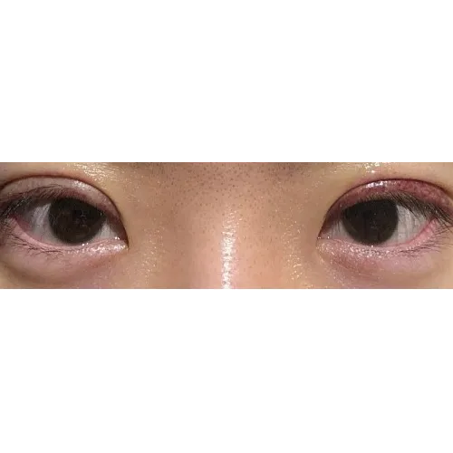 Puffy Eyelid Correction — Afternoon Plastic Surgery 5