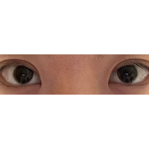 Puffy Eyelid Correction — Afternoon Plastic Surgery 6