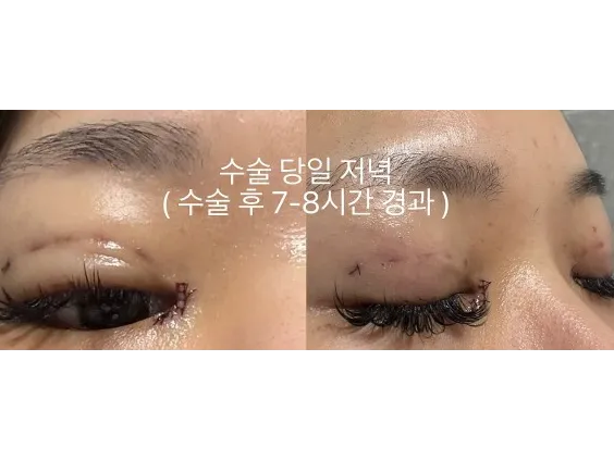 Non-incisional double eyelid surgery, Epicanthoplasty — Afternoon Plastic Surgery 3