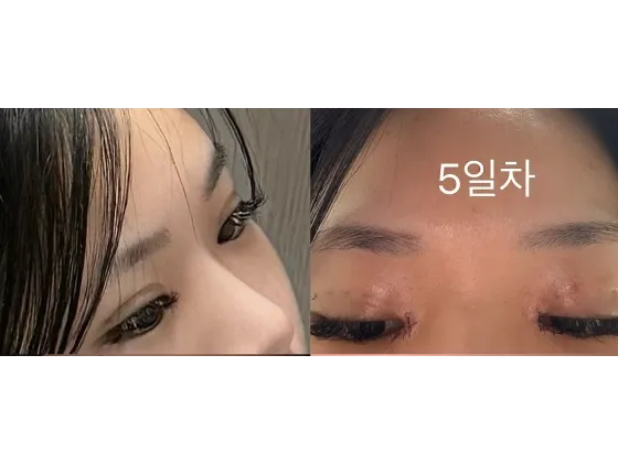 Non-incisional double eyelid surgery, Epicanthoplasty 2