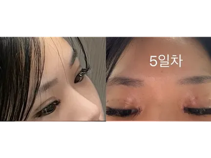 Non-incisional double eyelid surgery 2