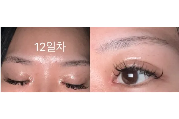 Non-incisional double eyelid surgery, Epicanthoplasty — Afternoon Plastic Surgery 4