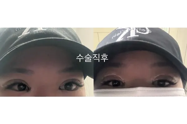 Non-incisional double eyelid surgery, Epicanthoplasty 1
