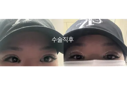 Non-incisional double eyelid surgery 1