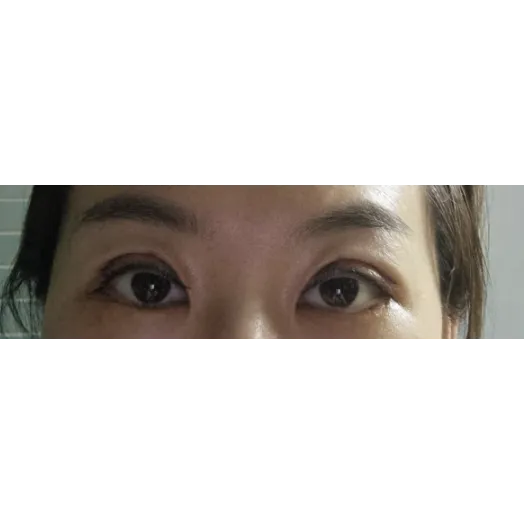 Revision ptosis correction, Incisional Double Eyelid Surgery, Lateral canthoplasty 1