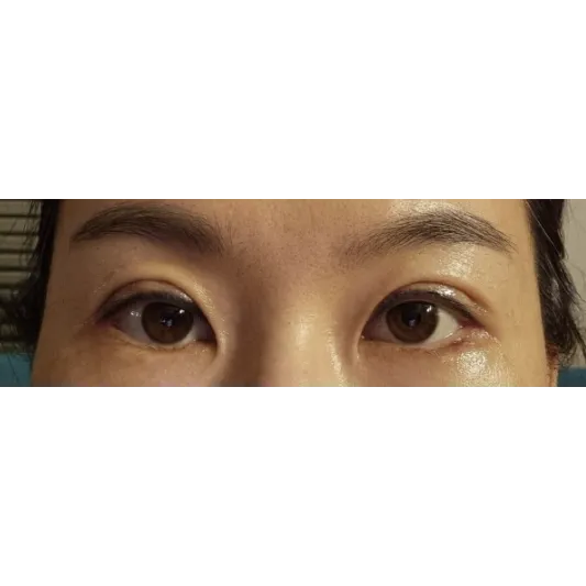 Revision ptosis correction, Incisional Double Eyelid Surgery, Lateral canthoplasty — Afternoon Plastic Surgery 2