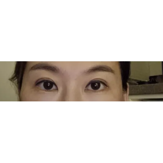 Revision ptosis correction, Incisional Double Eyelid Surgery, Lateral canthoplasty — Afternoon Plastic Surgery 3