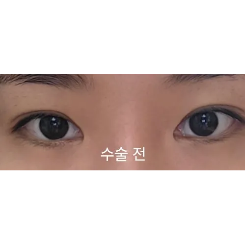 Non-incisional double eyelid surgery 1