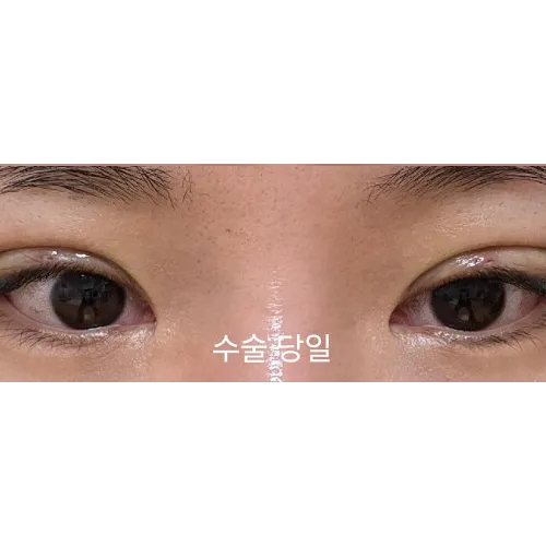 Non-incisional double eyelid surgery — Afternoon Plastic Surgery 2