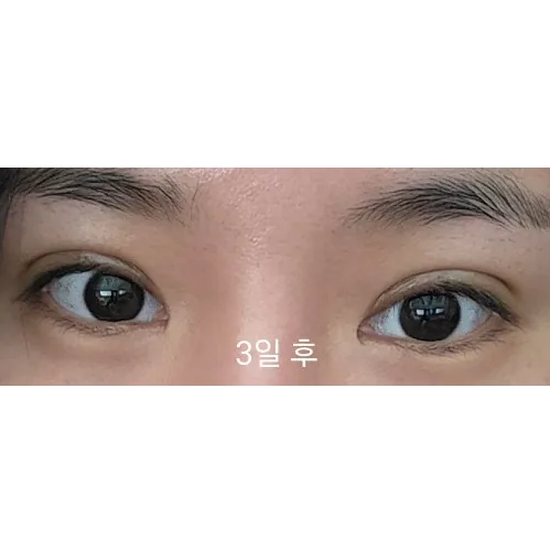 Non-incisional double eyelid surgery — Afternoon Plastic Surgery 3