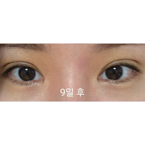 Non-incisional double eyelid surgery — Afternoon Plastic Surgery 4