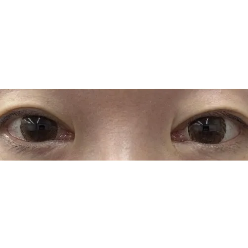 Epicanthoplasty Revision (Reconstruction) 1