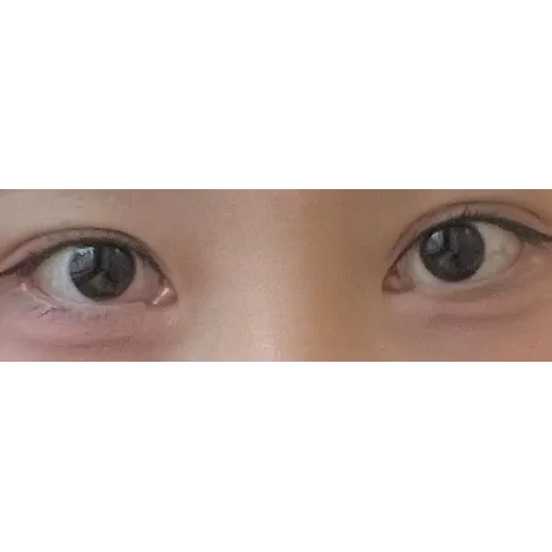 Epicanthoplasty Revision (Reconstruction) 1