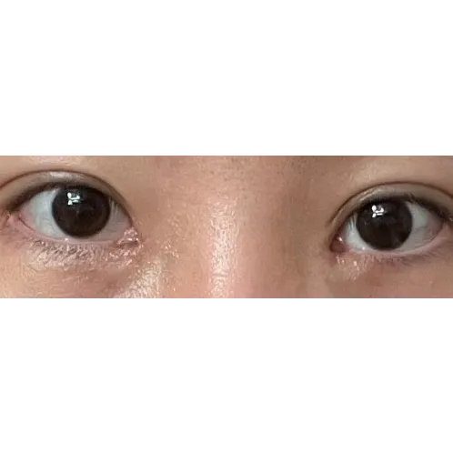 Epicanthoplasty Revision (Reconstruction) 2