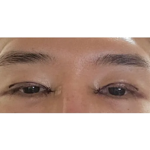Epicanthoplasty Revision (Reconstruction) — Afternoon Plastic Surgery 2