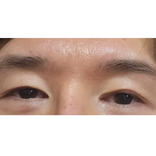 Epicanthoplasty Revision (Reconstruction) 1