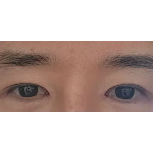 Epicanthoplasty Revision (Reconstruction) — Afternoon Plastic Surgery 3
