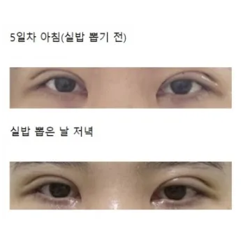 Incisional Double Eyelid Surgery, Revision ptosis correction — Afternoon Plastic Surgery 2