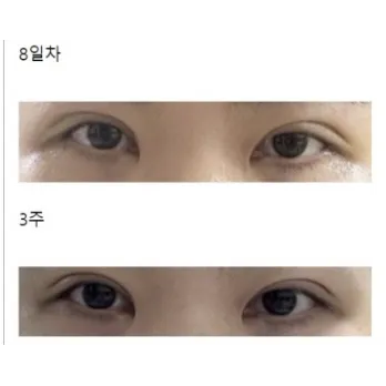 Incisional Double Eyelid Surgery, Revision ptosis correction — Afternoon Plastic Surgery 3