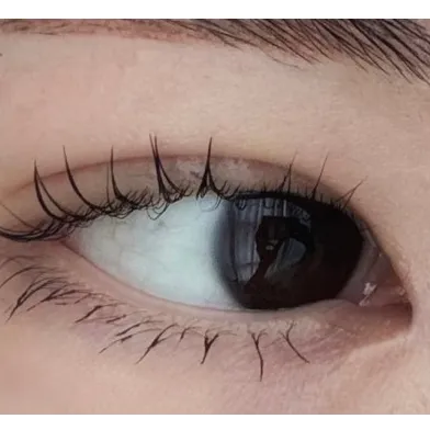 Non-incisional double eyelid surgery, Epicanthoplasty 2