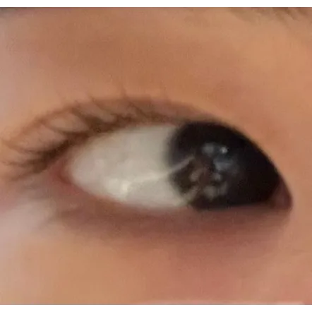 Non-incisional double eyelid surgery, Epicanthoplasty — Afternoon Plastic Surgery 3