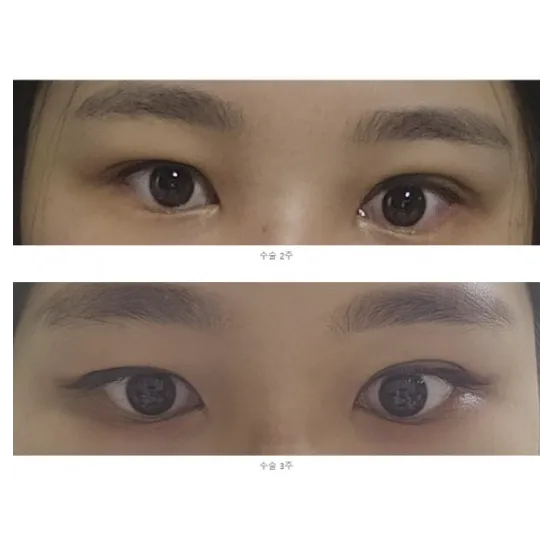 Incisional Double Eyelid Surgery, Revision ptosis correction — Afternoon Plastic Surgery 2