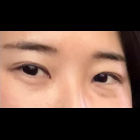 Lower Eyelid Fat Repositioning 1