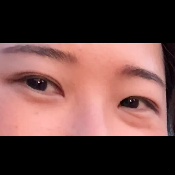 Lower Eyelid Fat Repositioning 2