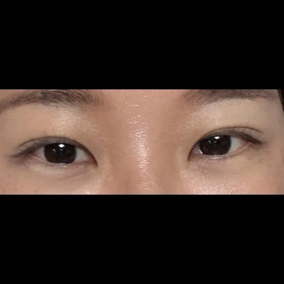 Lower Eyelid Fat Repositioning — Afternoon Plastic Surgery 3