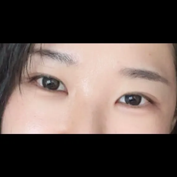 Lower Eyelid Fat Repositioning — Afternoon Plastic Surgery 4