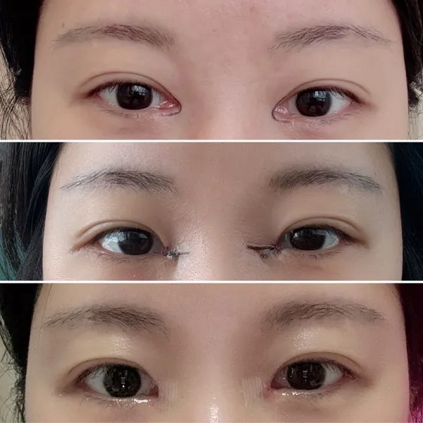Epicanthoplasty Revision (Reconstruction) — Afternoon Plastic Surgery 1