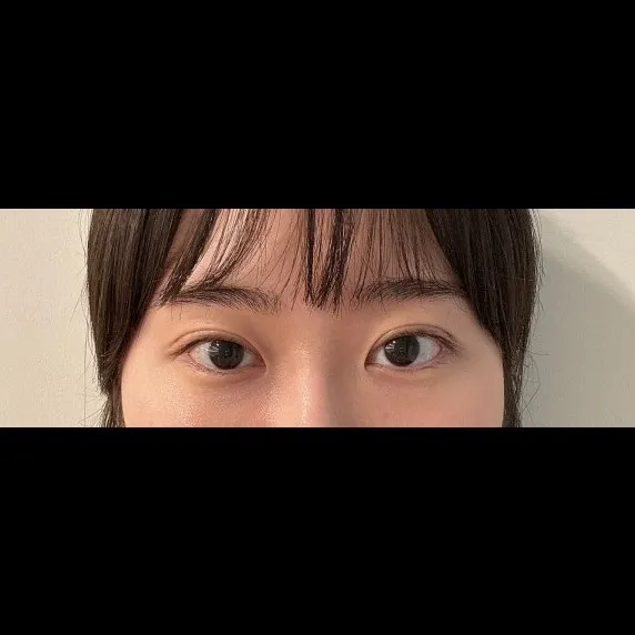 Revision ptosis correction — Afternoon Plastic Surgery 2