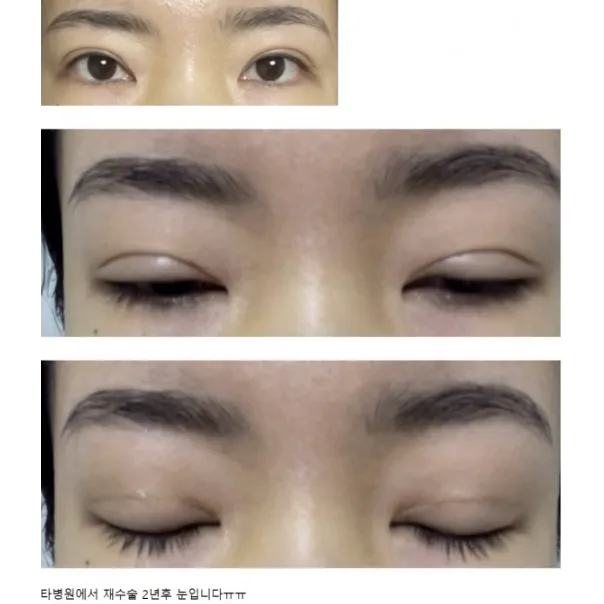 Incisional Double Eyelid Surgery, Revision ptosis correction 1