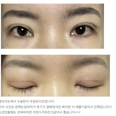 Incisional Double Eyelid Surgery, Revision ptosis correction 2