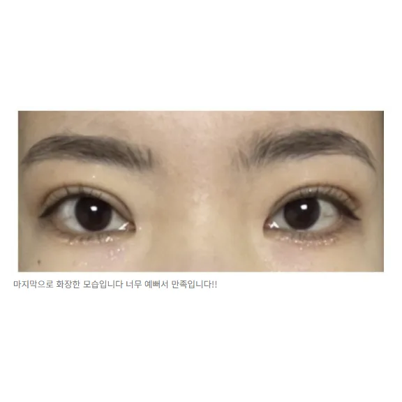 Incisional Double Eyelid Surgery, Revision ptosis correction — Afternoon Plastic Surgery 3