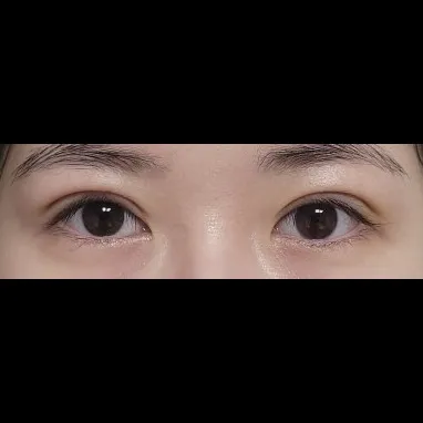 Revision ptosis correction — Afternoon Plastic Surgery 2