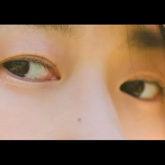 Ptosis Correction, Lower Eyelid Fat Repositioning 1