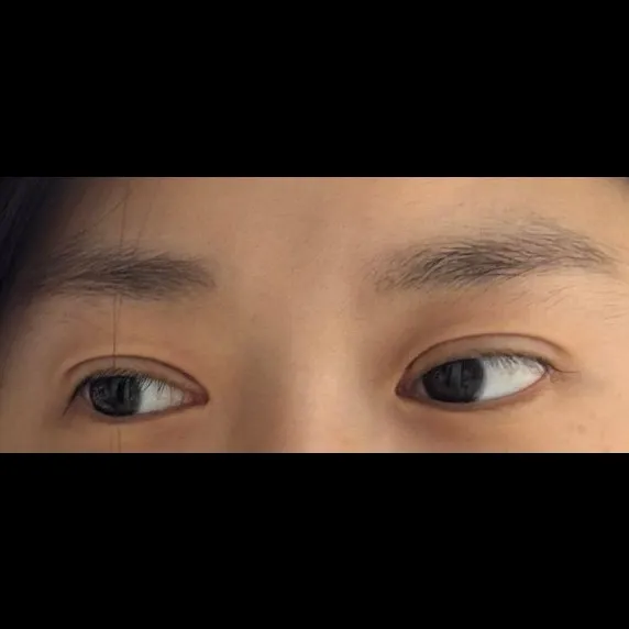 Ptosis Correction, Lower Eyelid Fat Repositioning 2