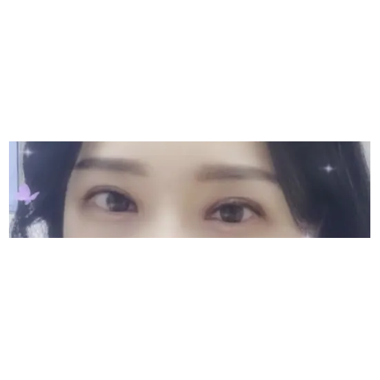 Incisional Double Eyelid Surgery — Afternoon Plastic Surgery 2